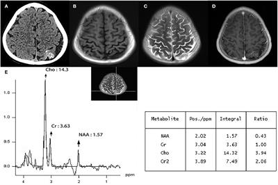 Magnetic Resonance Spectroscopy May Help Diagnose Sporadic Meningioangiomatosis Associated With Meningioma: A Case Report